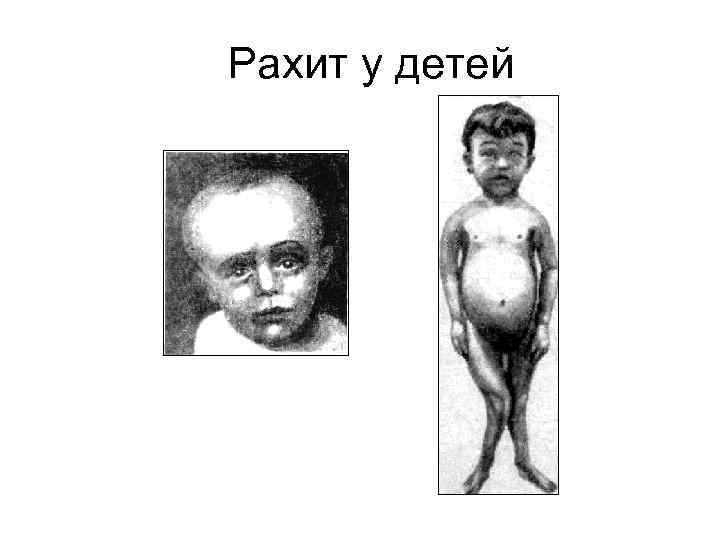 Рахит у детей 