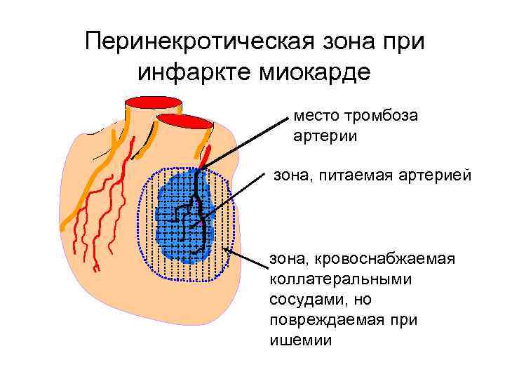 Перинекротическая зона при инфаркте миокарде место тромбоза артерии зона, питаемая артерией зона, кровоснабжаемая коллатеральными