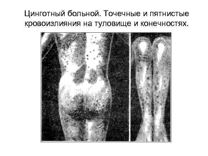 Цинготный больной. Точечные и пятнистые кровоизлияния на туловище и конечностях. 