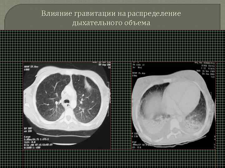 Влияние гравитации на распределение дыхательного объема 