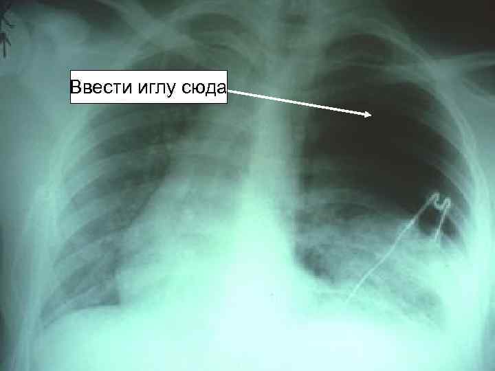 Ввести иглу сюда 