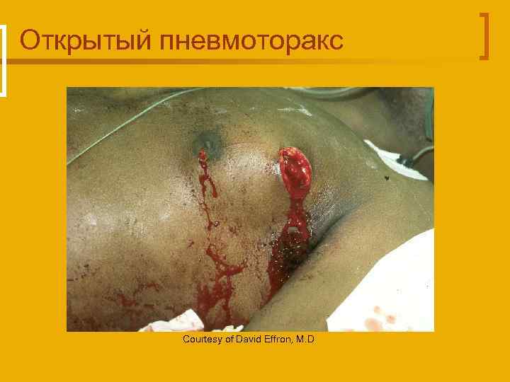 Открытый пневмоторакс Courtesy of David Effron, M. D. 