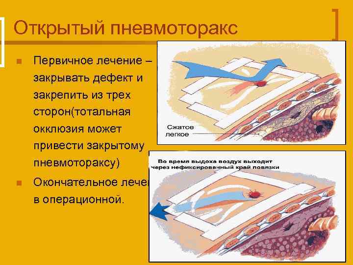 Открытый пневмоторакс n Первичное лечение – закрывать дефект и закрепить из трех сторон(тотальная окклюзия