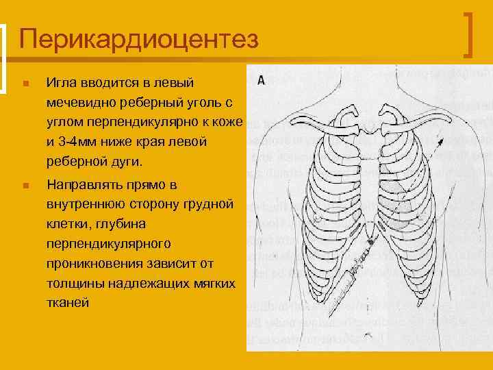 Мечевидный отросток грудины. Мечевидный отросток край грудины. Отросток под грудной клеткой. Край реберной дуги. Проекция мечевидного отростка.