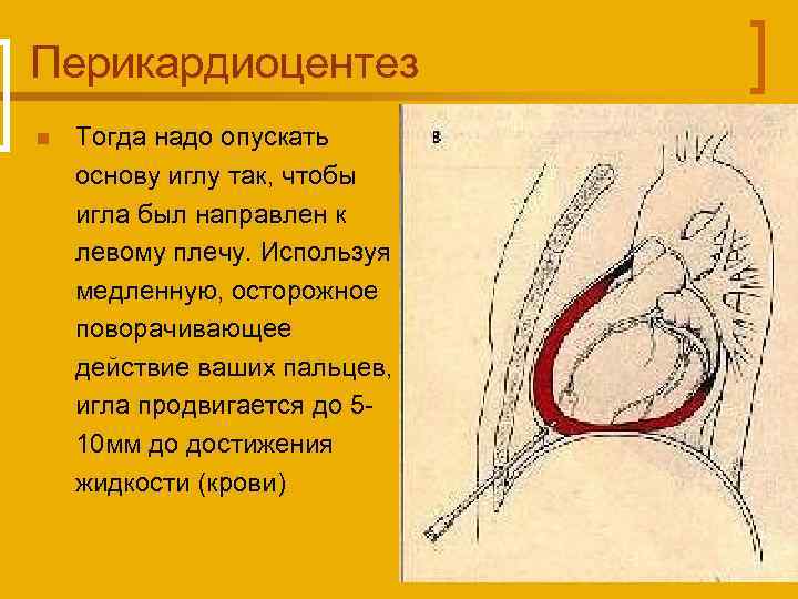 Перикардиоцентез n Тогда надо опускать основу иглу так, чтобы игла был направлен к левому
