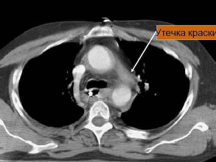 Утечка краски 