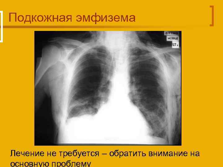 Подкожная эмфизема Лечение не требуется – обратить внимание на основную проблему 