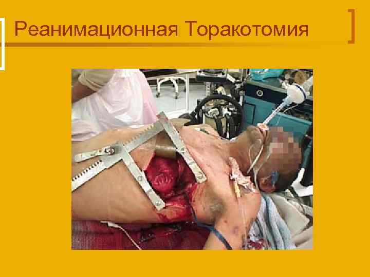 Реанимационная Торакотомия 
