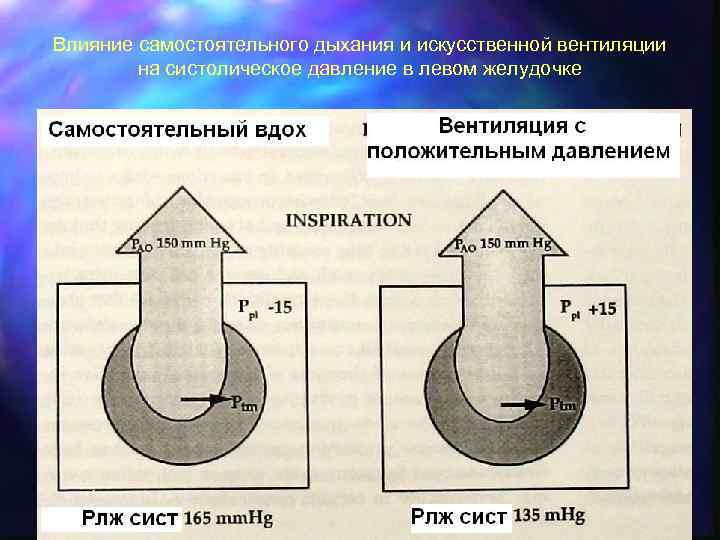 Влияние самостоятельного дыхания и искусственной вентиляции на систолическое давление в левом желудочке 