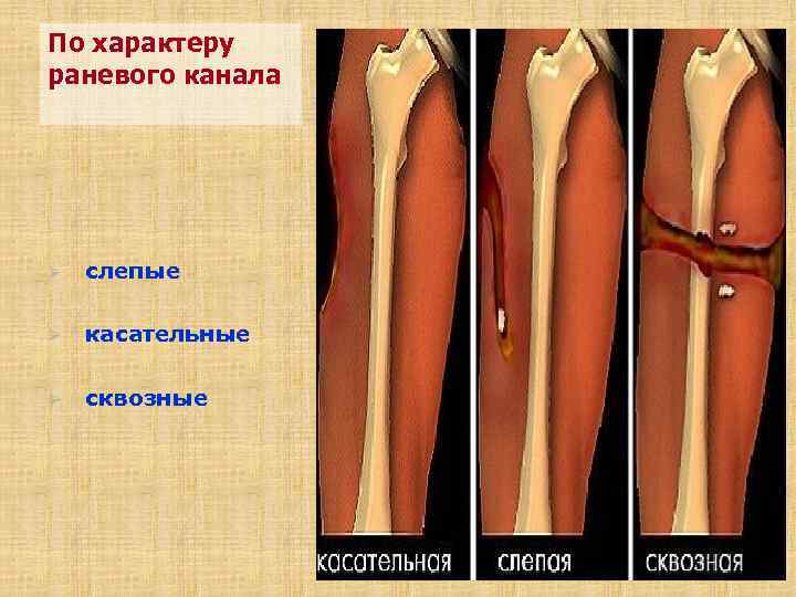 По характеру раневого канала Ø слепые Ø касательные Ø сквозные 