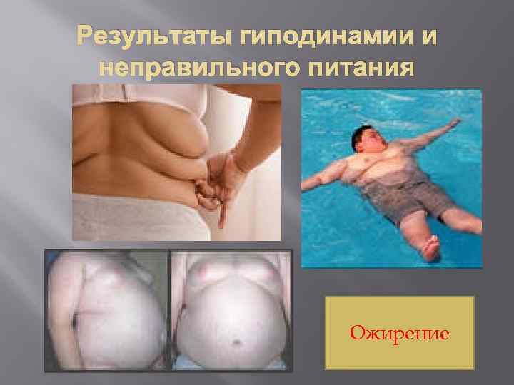Результаты гиподинамии и неправильного питания Ожирение 