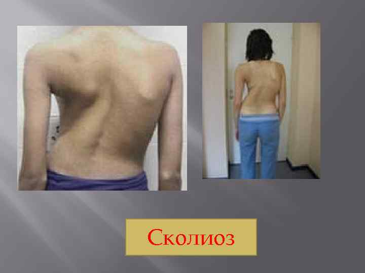 Сколиоз 
