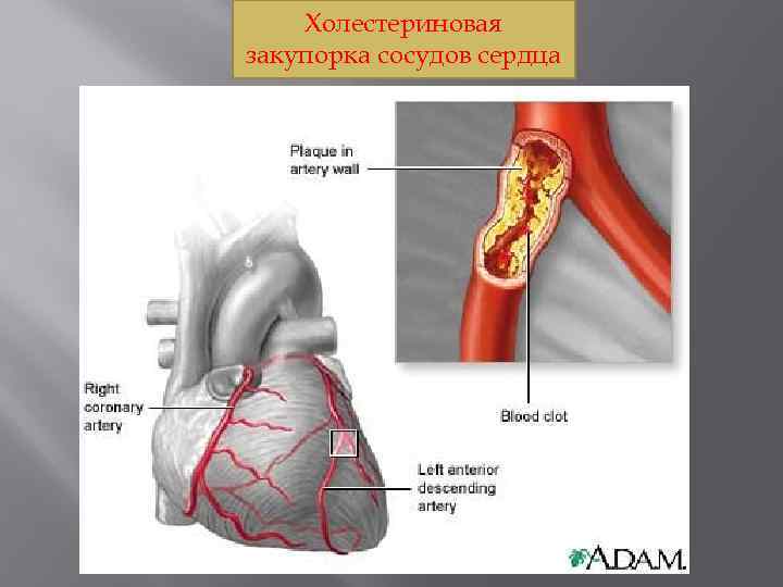 Холестериновая закупорка сосудов сердца 