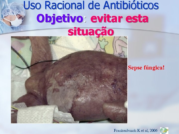 Uso Racional de Antibióticos Objetivo: evitar esta situação Sepse fúngica! Frankenbusch K et al,