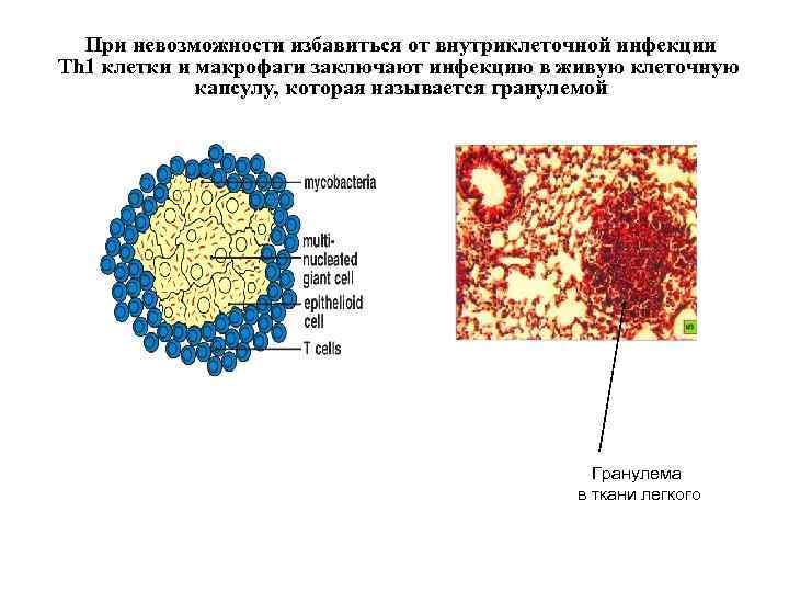 При невозможности избавиться от внутриклеточной инфекции Th 1 клетки и макрофаги заключают инфекцию в