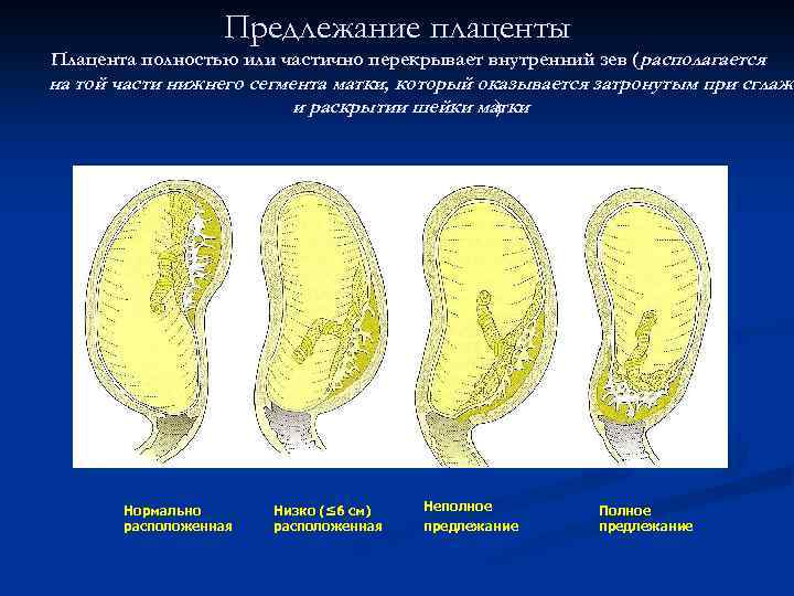 Предлежание плаценты Плацента полностью или частично перекрывает внутренний зев (располагается на той части нижнего