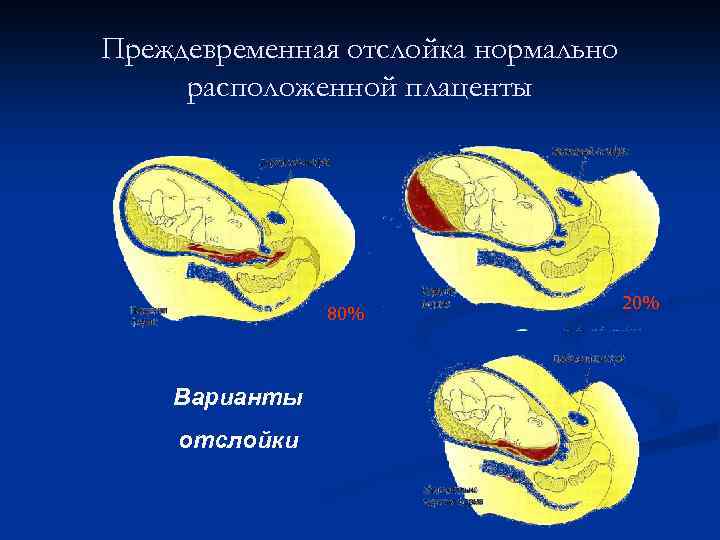 Предлежание плаценты отслойка. Карта вызова преждевременная отслойка плаценты. Преждевременная отслойка нормально расположенной плаценты. Преждевременная отслойка плаценты клинические рекомендации. Можно ли почувствовать ли отслойка плаценты.