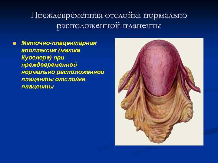 Преждевременная отслойка нормально расположенной плаценты n Маточно-плацентарная апоплексия (матка Кувелера) при преждевременной нормально расположенной