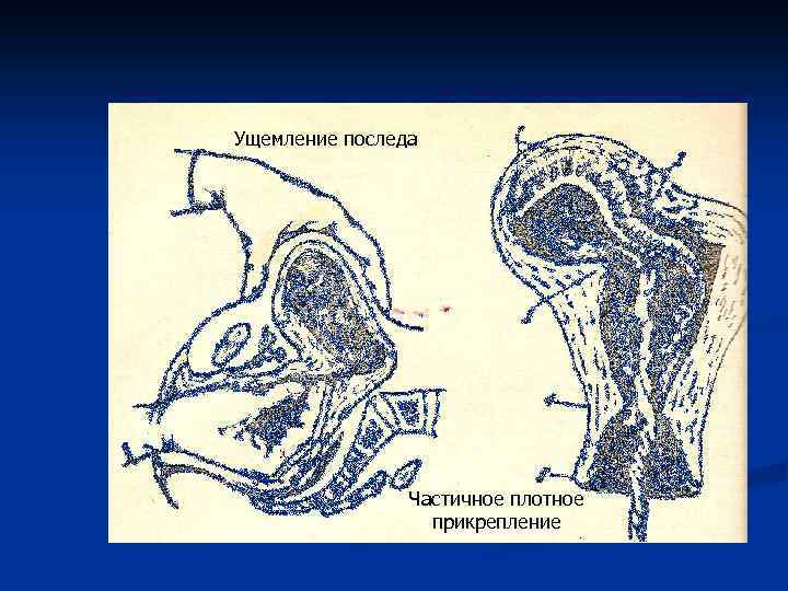 Ущемление последа Частичное плотное прикрепление 