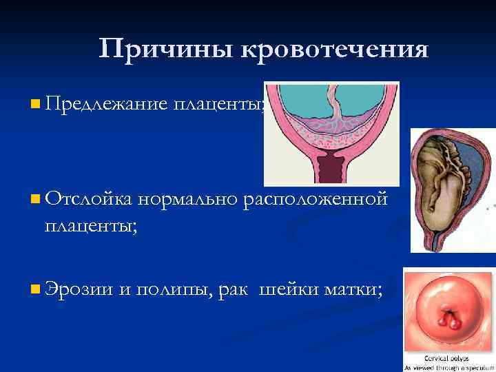 Причины кровотечения n Предлежание n Отслойка плаценты; нормально расположенной плаценты; n Эрозии и полипы,