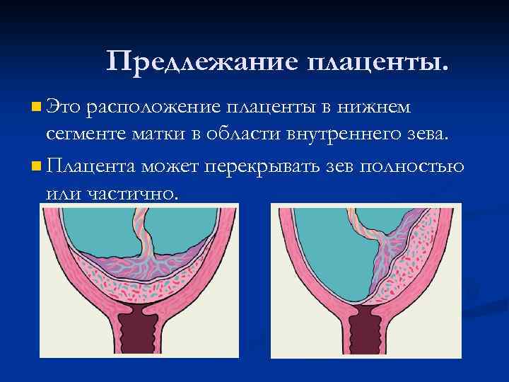 Зев закрыт при беременности. Нижний край плаценты у внутреннего зева. Плацента перекрывает внутренний зев. Перекрытие внутреннего зева плацентой. Задняя стенка матки перекрывает внутренний зев.
