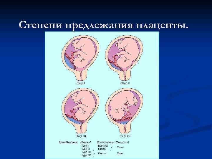 Степени предлежания плаценты. 