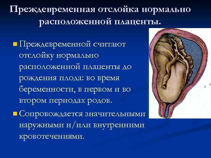 Преждевременная отслойка нормально расположенной плаценты. n Преждевременной считают отслойку нормально расположенной плаценты до рождения