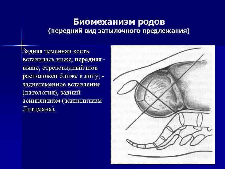 Роды в затылочном предлежании фото