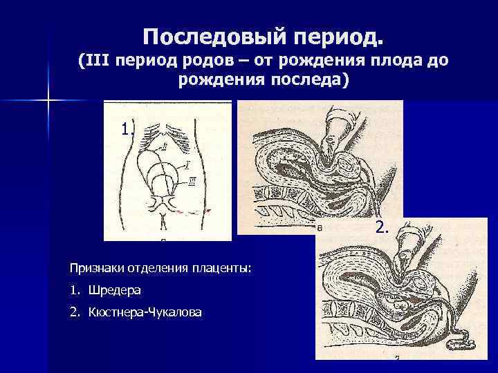 Признак рождения ребенка. Третий период родов Последовый период. Признак отделения плаценты Кюстнера-Чукалова. Период рождения последа.