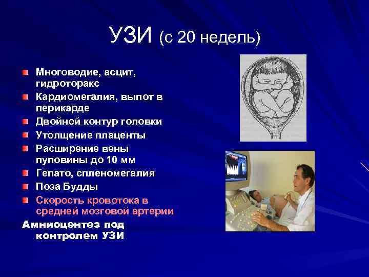 УЗИ (с 20 недель) Многоводие, асцит, гидроторакс Кардиомегалия, выпот в перикарде Двойной контур головки
