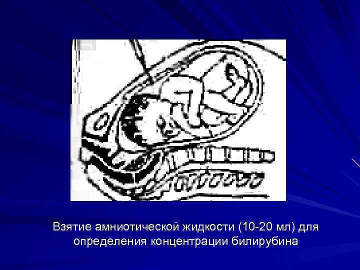 Взятие амниотической жидкости (10 -20 мл) для определения концентрации билирубина 