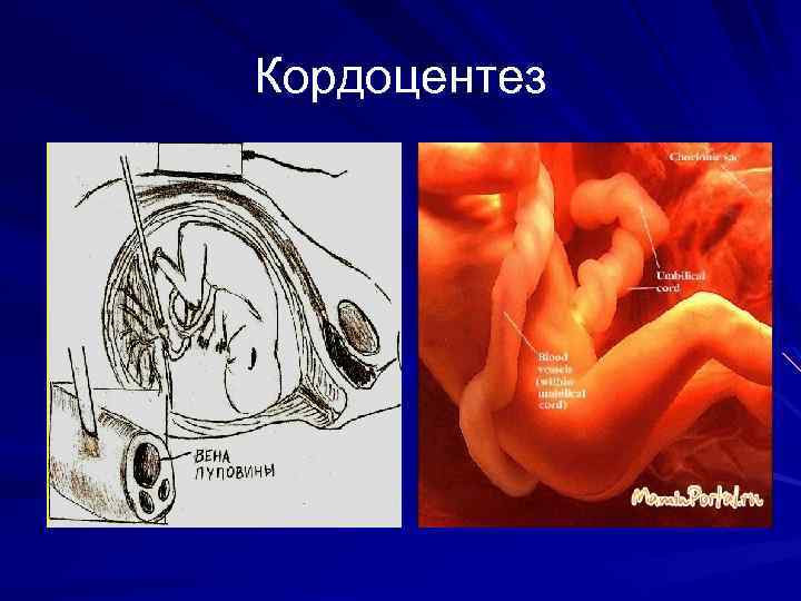 Иммуноконфликтная беременность презентация