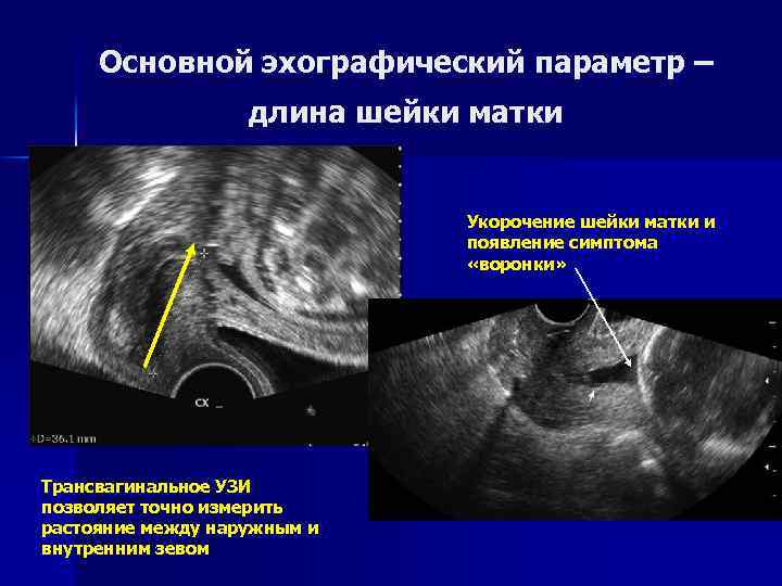 Матка 12 мм. УЗИ беременность шейка норма. Открытый внутренний зев на УЗИ. Раскрытие внутреннего зева УЗИ. Ультразвуковое исследование шейки матки.