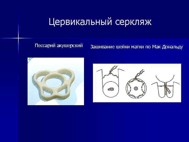 Цервикальный серкляж Пессарий акушерский Зашивание шейки матки по Мак Дональду 