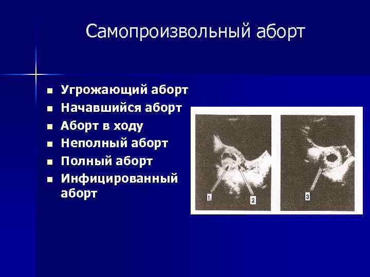 Самопроизвольный аборт n n n Угрожающий аборт Начавшийся аборт Аборт в ходу Неполный аборт