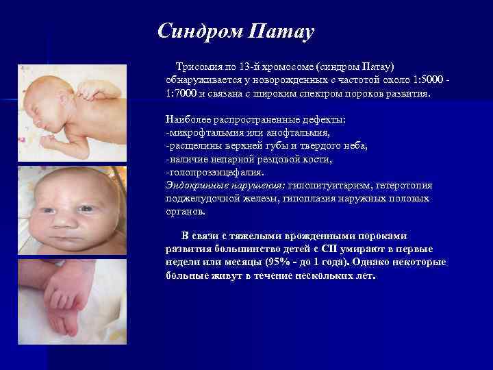 Синдром Патау Трисомия по 13 -й хромосоме (синдром Патау) обнаруживается у новорожденных с частотой