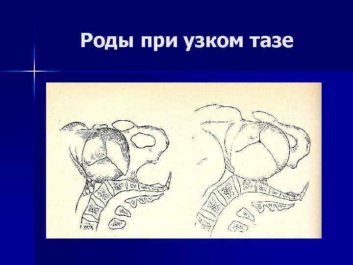 План ведения родов при узком тазе