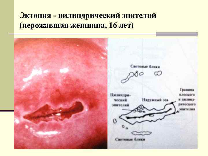 Эктопия - цилиндрический эпителий (нерожавшая женщина, 16 лет) 