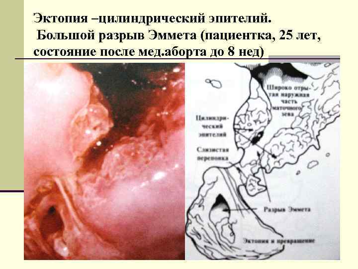 Эктопия –цилиндрический эпителий. Большой разрыв Эммета (пациентка, 25 лет, состояние после мед. аборта до