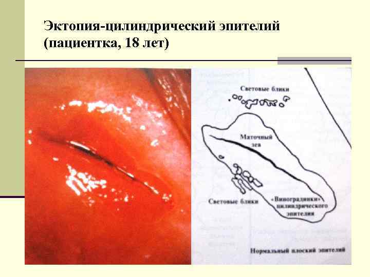 Эктопия-цилиндрический эпителий (пациентка, 18 лет) 