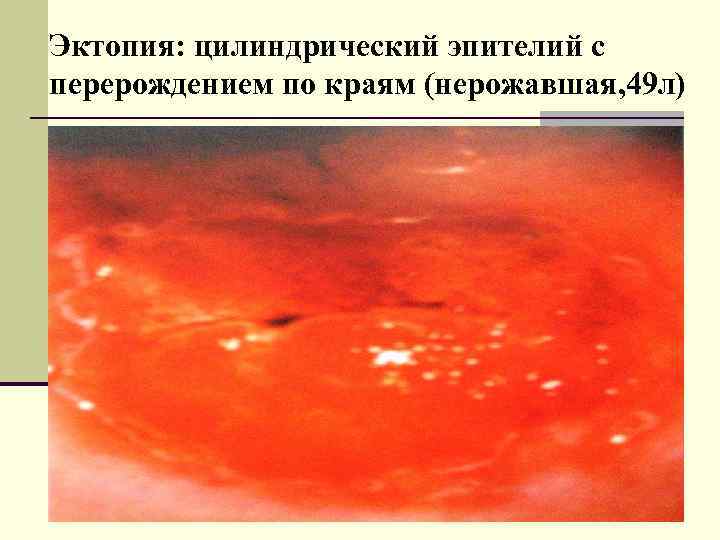 Эктопия: цилиндрический эпителий с перерождением по краям (нерожавшая, 49 л) 