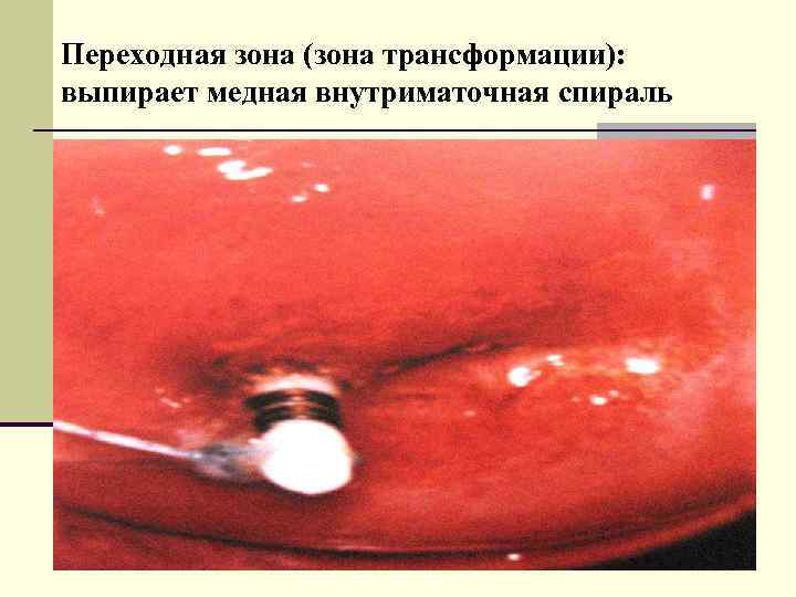 Переходная зона (зона трансформации): выпирает медная внутриматочная спираль 