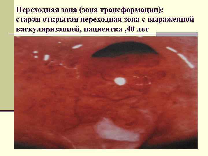 Переходная зона (зона трансформации): старая открытая переходная зона с выраженной васкуляризацией, пациентка , 40