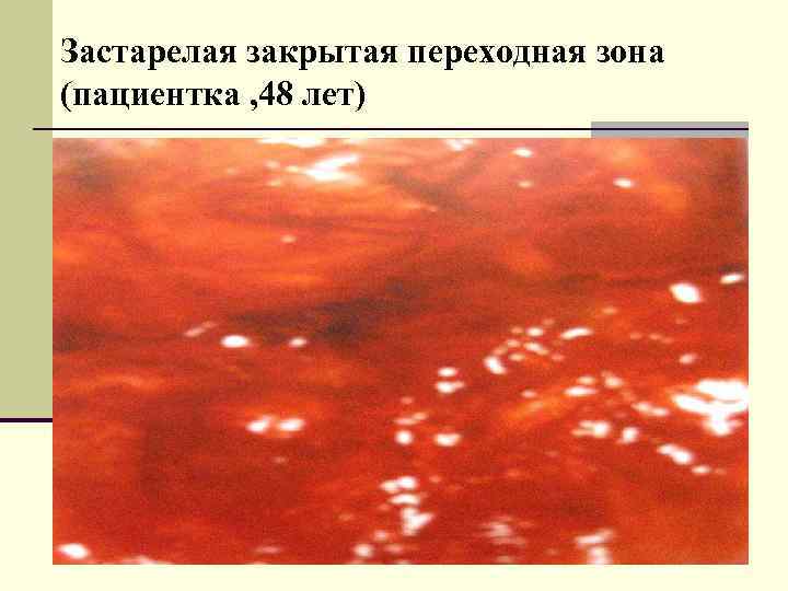 Застарелая закрытая переходная зона (пациентка , 48 лет) 