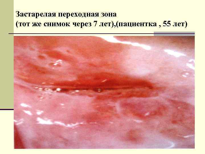 Застарелая переходная зона (тот же снимок через 7 лет), (пациентка , 55 лет) 