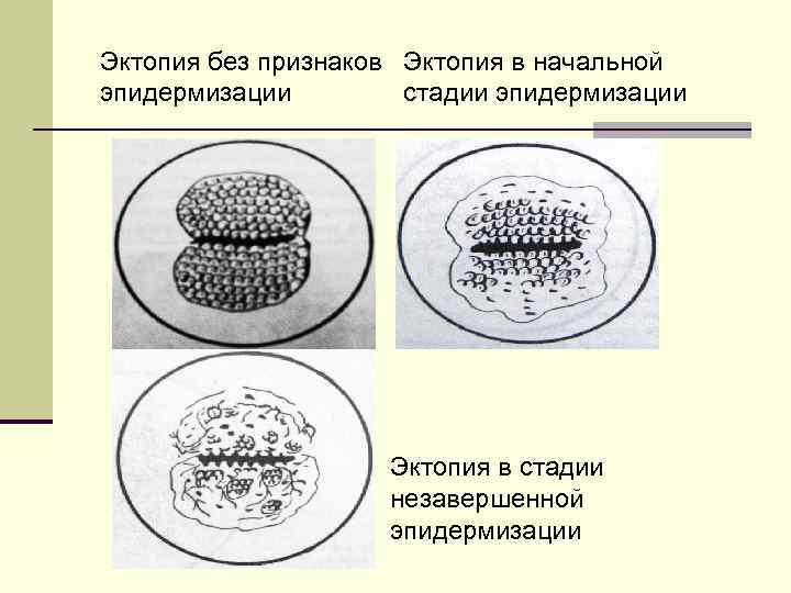 Эктопия без признаков Эктопия в начальной эпидермизации стадии эпидермизации Эктопия в стадии незавершенной эпидермизации