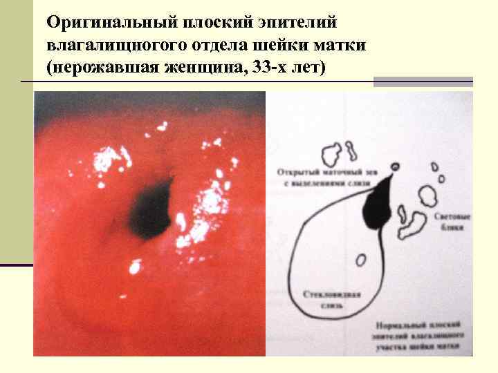Оригинальный плоский эпителий влагалищногого отдела шейки матки (нерожавшая женщина, 33 -х лет) 