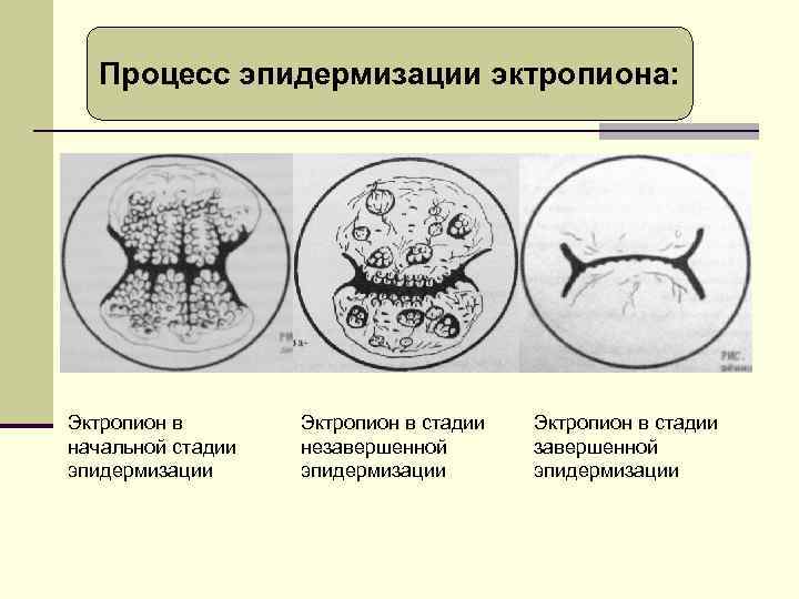 Процесс эпидермизации эктропиона: Эктропион в начальной стадии эпидермизации Эктропион в стадии незавершенной эпидермизации Эктропион