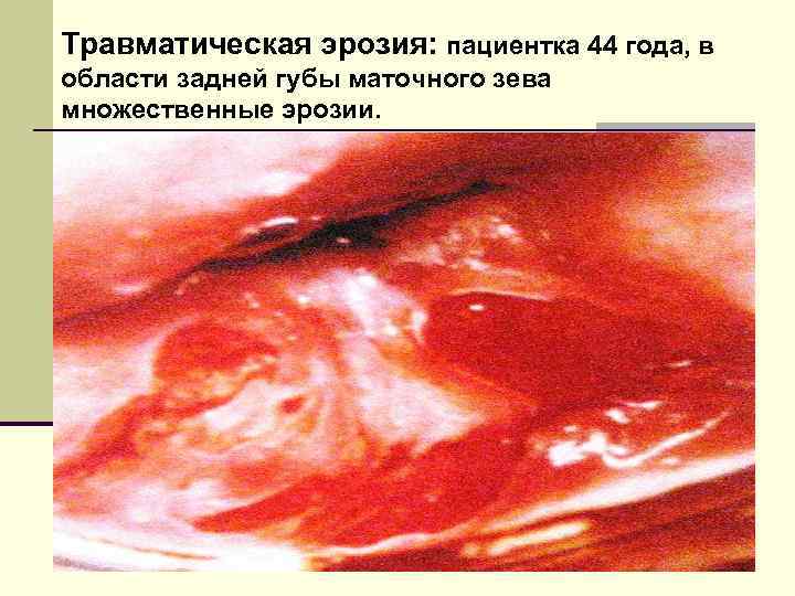 Травматическая эрозия: пациентка 44 года, в области задней губы маточного зева множественные эрозии. 
