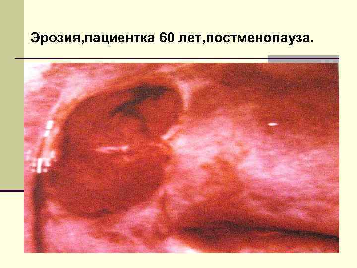 Эрозия, пациентка 60 лет, постменопауза. 